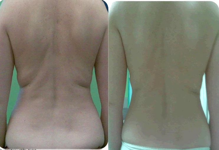 Back Injection Before and After